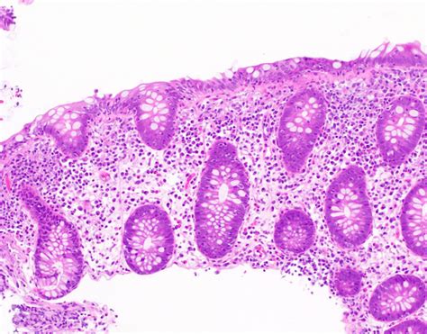 Can lexapro cause microscopic colitis - See full list on mayoclinic.org 